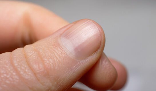 Fingernägel als Indikator für die Gesundheit